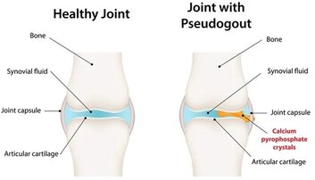 Comparaison entre une articulation saine et une avec pseudogoutte.