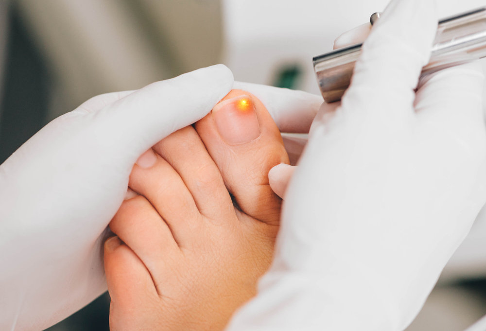 élimination des champignons des ongles au laser