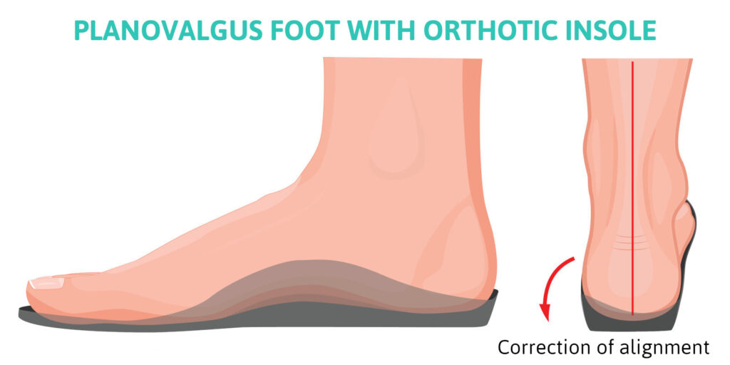 correction de la pronation des pieds plats par orthèses