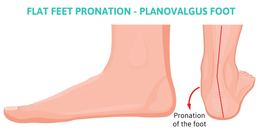 pronation pieds plats