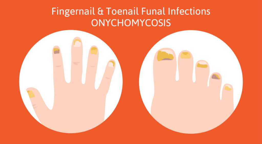 traitement laser mycose des ongles